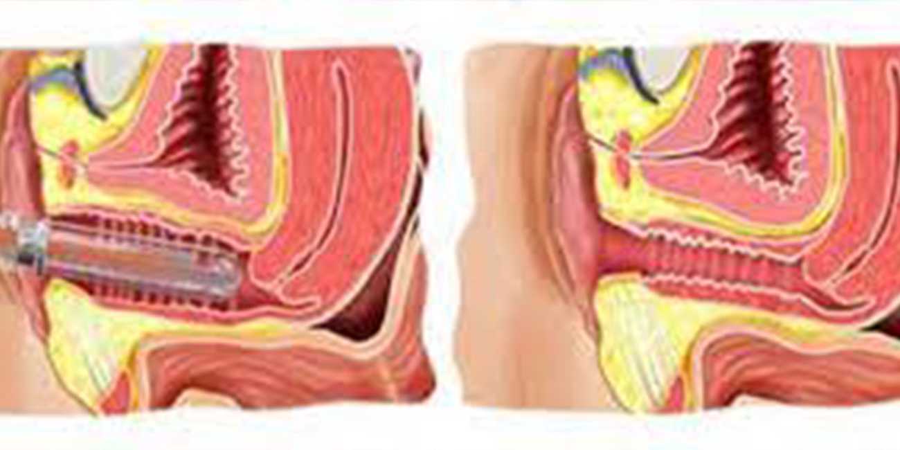 老外的新科技 高科技阴道阴唇紧缩术 几分钟就搞定